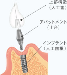 インプラントの構造