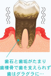 歯石と歯垢がたまり歯槽骨で歯を支えられず歯はグラグラに…