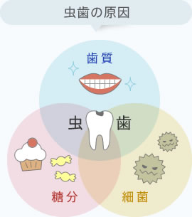 虫歯の原因「歯質」「細菌」「糖分」